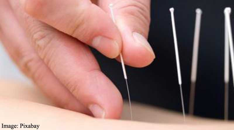 Acupuncture can relieve lower back and pelvic pain during pregnancy: Study