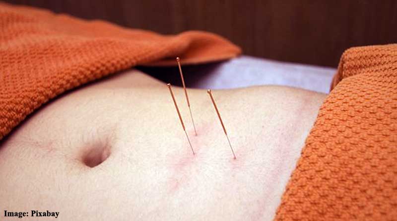 Acupuncture treatment safe and helpful for diarrhea-predominant irritable bowel syndrome patients