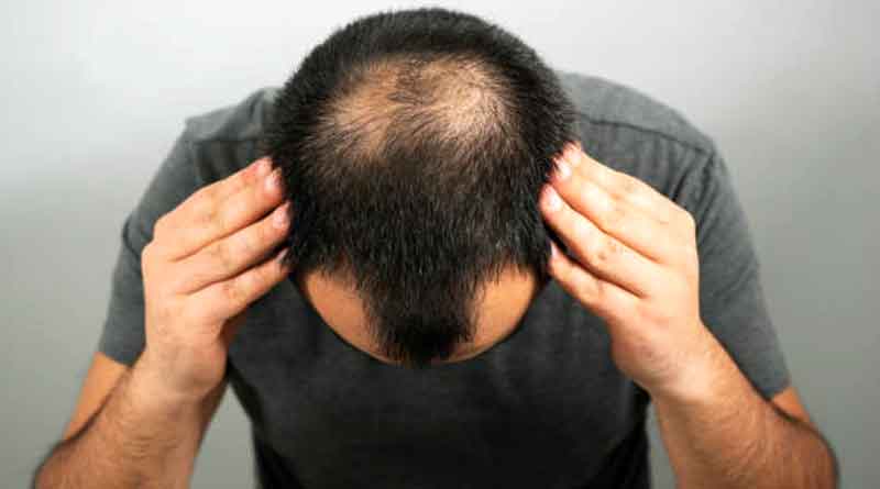 sugar-sweetened beverage consumption may trigger male pattern hair loss in young males: Study