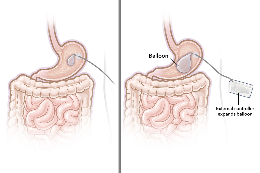 alt="MIT-Gastric-Balloon"